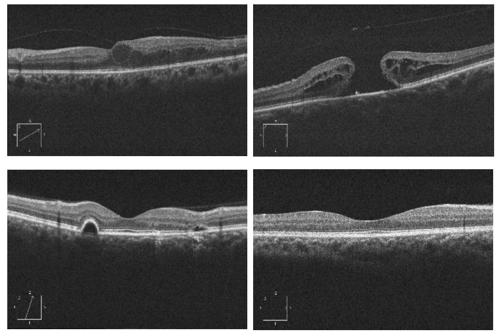 Retinal Disease Detection